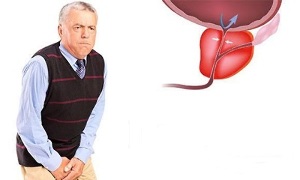 Symptoms of male prostatitis