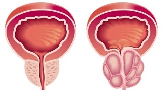 Causes of prostatitis and prostate adenoma development